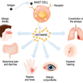 seasonal allergy symptoms